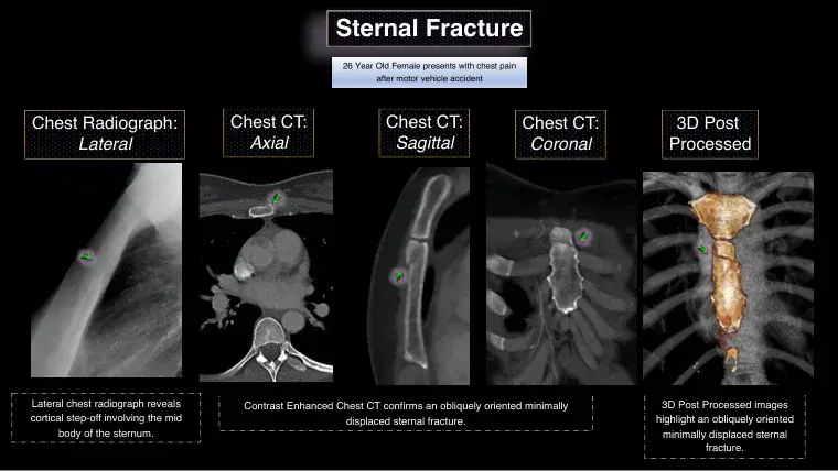 Cover of Overview of Chest Wall Osteocartilaginous Injury